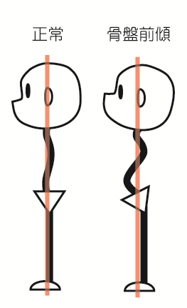骨盤前傾