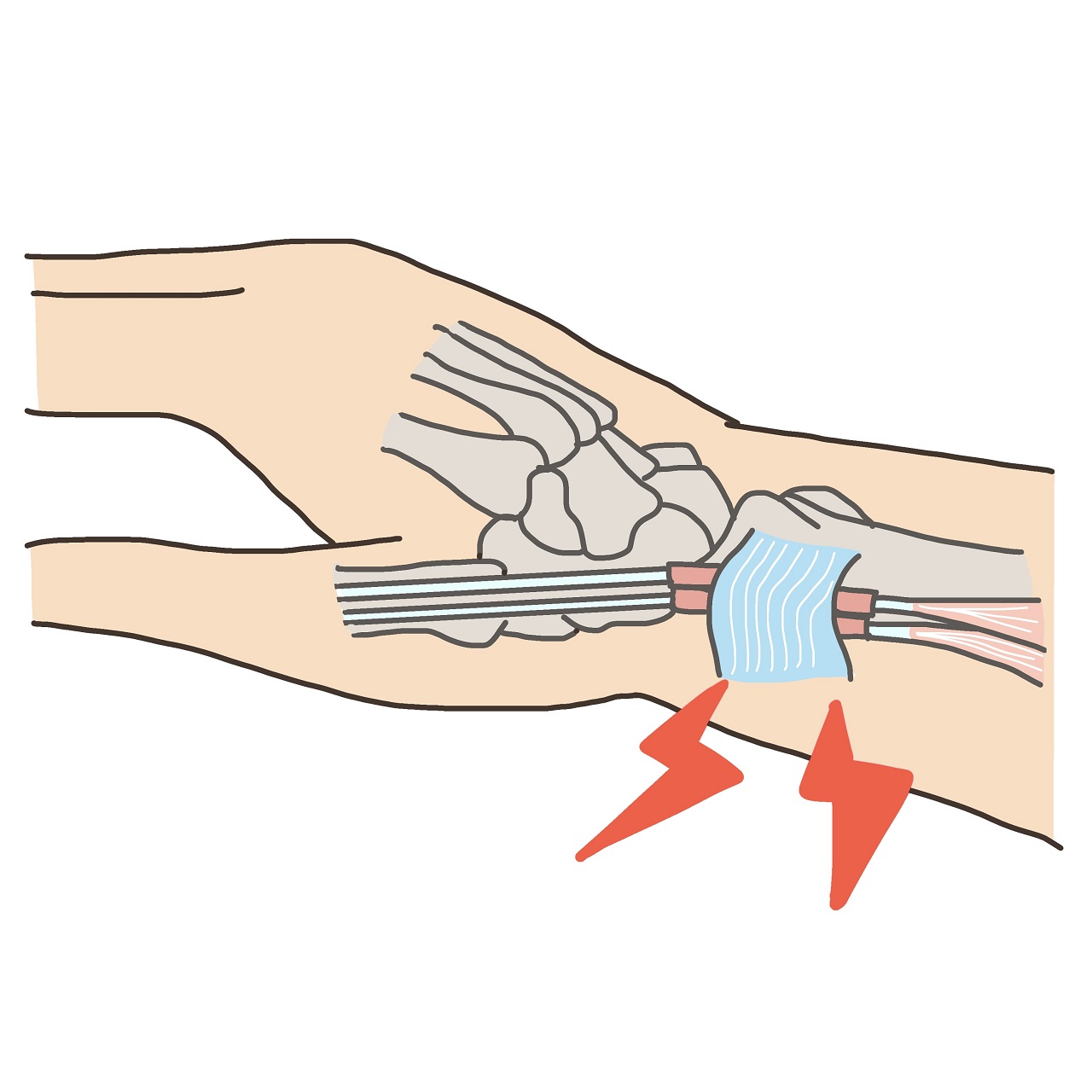ドケルバン腱鞘炎